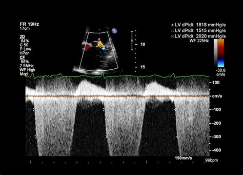 lv dp/dt max|global left ventricular systolic function.